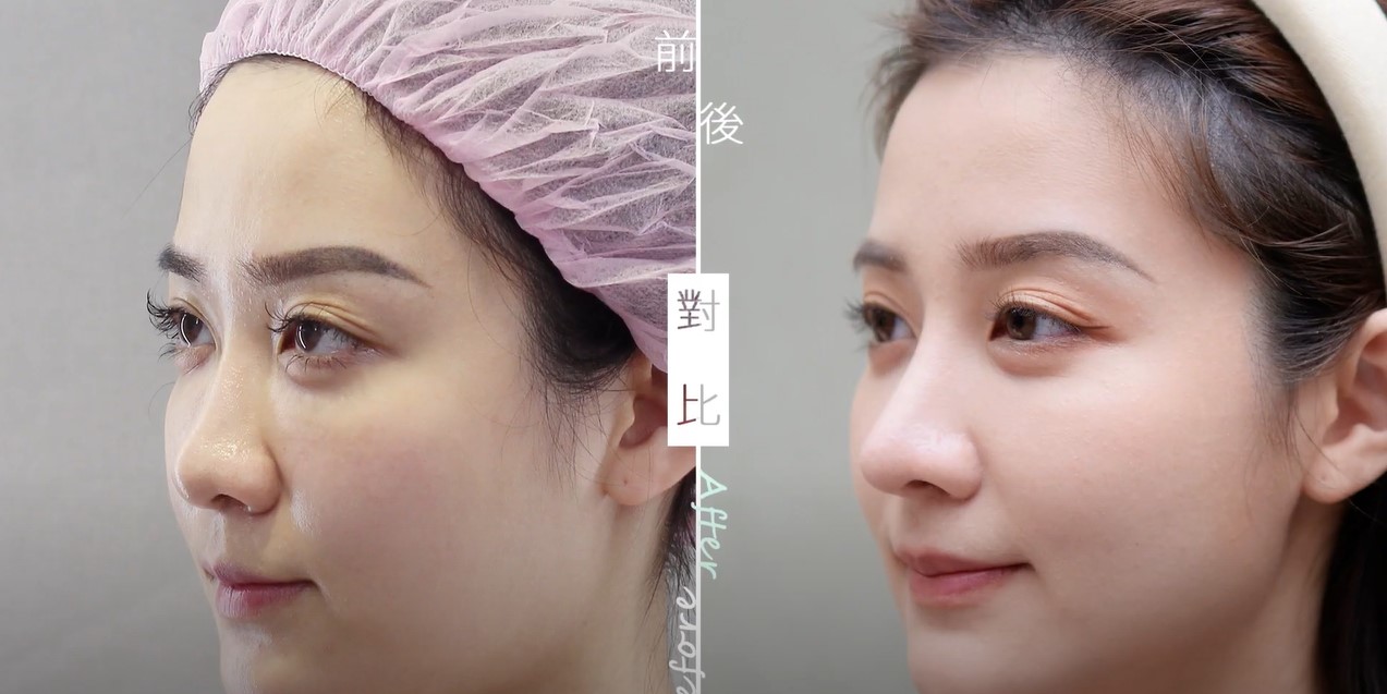【半自肋結構式鼻整形|自體肋骨】
