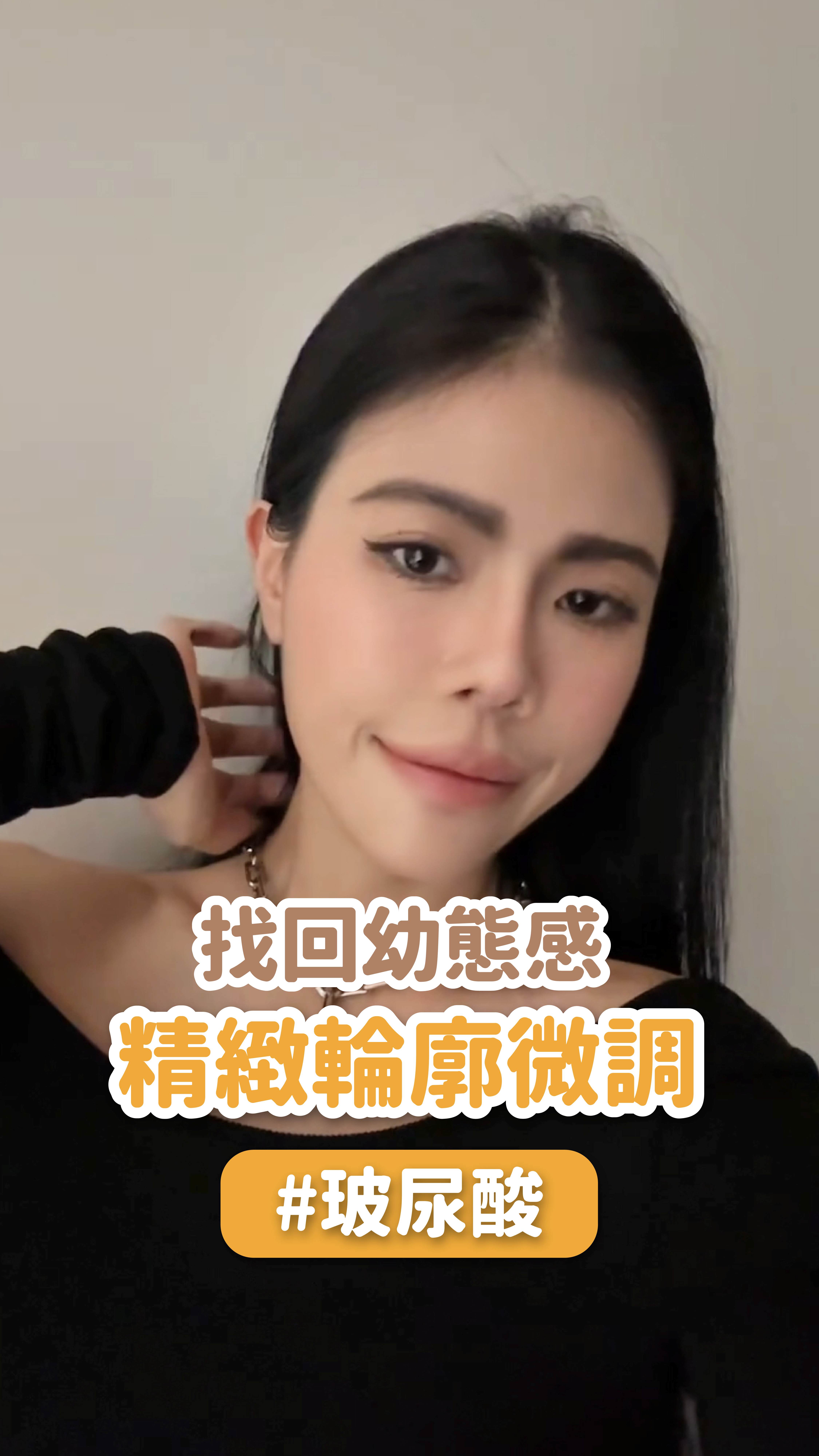 找回幼態感！星和醫美女神玻尿酸，精緻輪廓微調