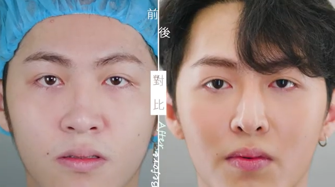 三段式隆鼻+縮鼻翼