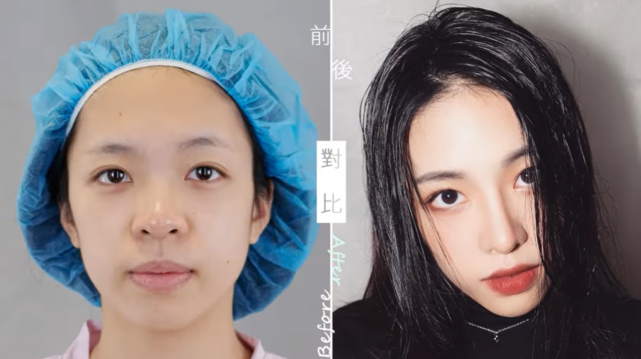 三段式隆鼻