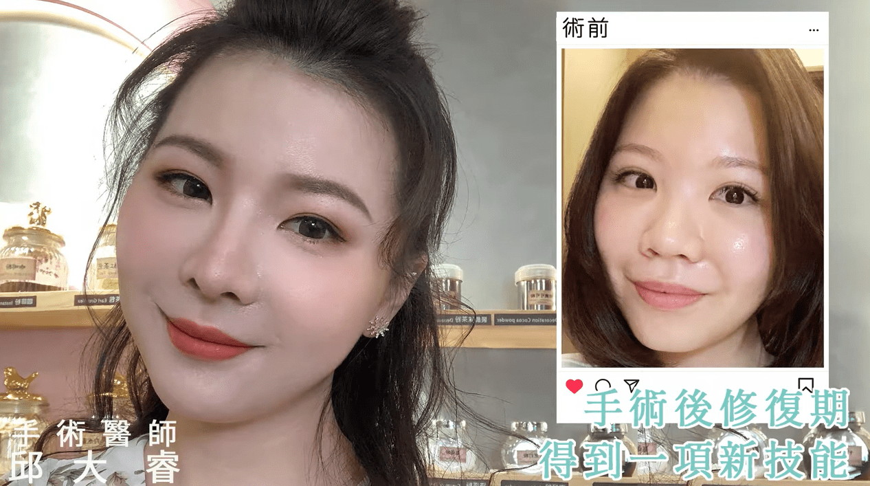 三段式隆鼻