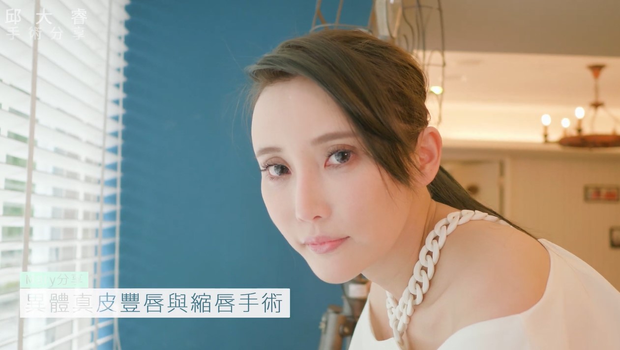 自體脂肪填補+三段式隆鼻+墊法令+唇整形