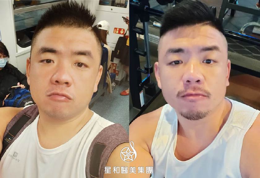 【玻尿酸山根+下巴】星和診所（新竹）-薛博今醫師-人生短短幾個秋，玻尿酸讓你不美不罷休！(上)-Jako