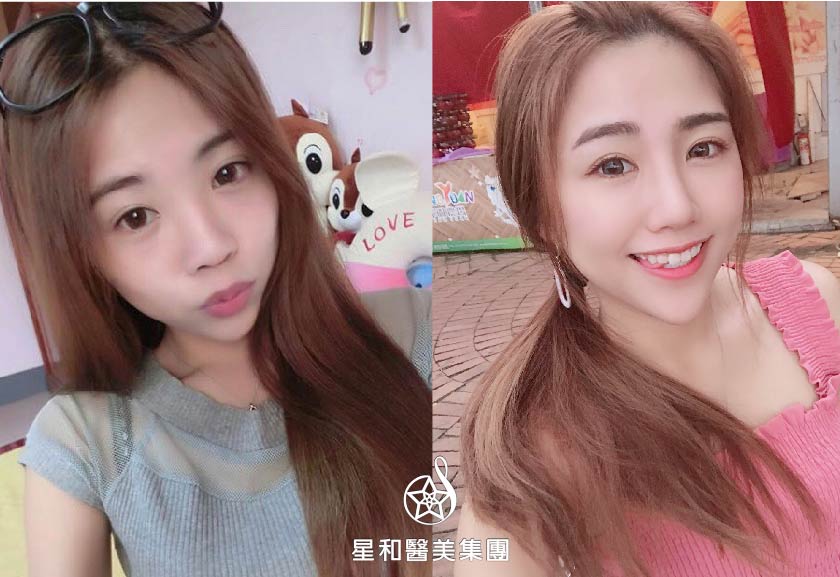 【玻尿酸補淚溝、山根】星和診所/高雄醫美-淚溝再也不見，還我自然自信美(上)-鄭思涵