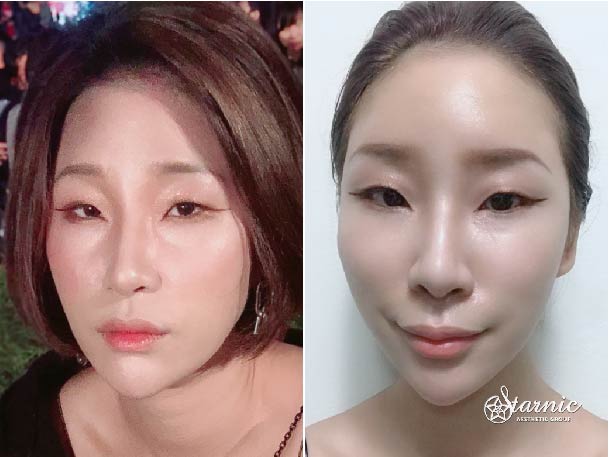 【玻尿酸蘋果肌/法令紋+晶亮瓷豐額】星和診所/台中醫美-愛心顏GET！補救我的凹陷厭世臉！-Bonnie