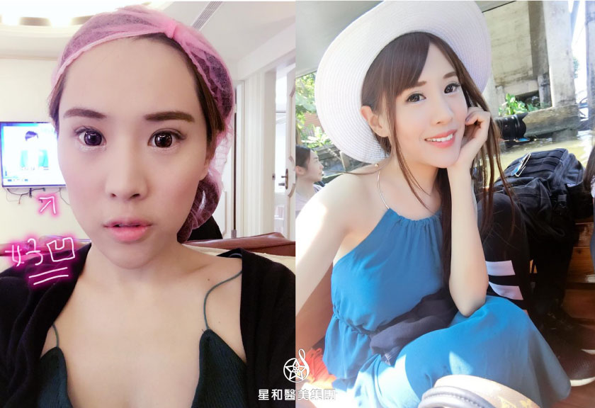 【玻尿酸】星采皮膚專科診所(古亭)-拯救臉凹苦命兒- Hi chia恰女孩