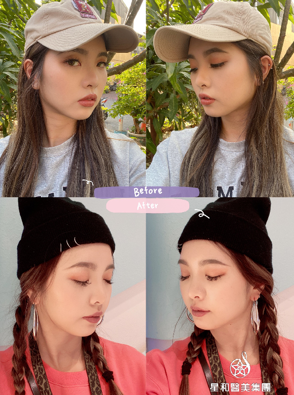 【肉毒瘦小臉+除皺】星和診所/台南醫美-改善大小臉！愛美就追求不需要隱瞞-雙胞胎媽咪阿普 (中)