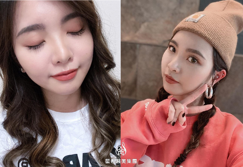 【肉毒瘦小臉+除皺】星和診所/台南醫美-改善大小臉！愛美就追求不需要隱瞞-雙胞胎媽咪阿普 (下)