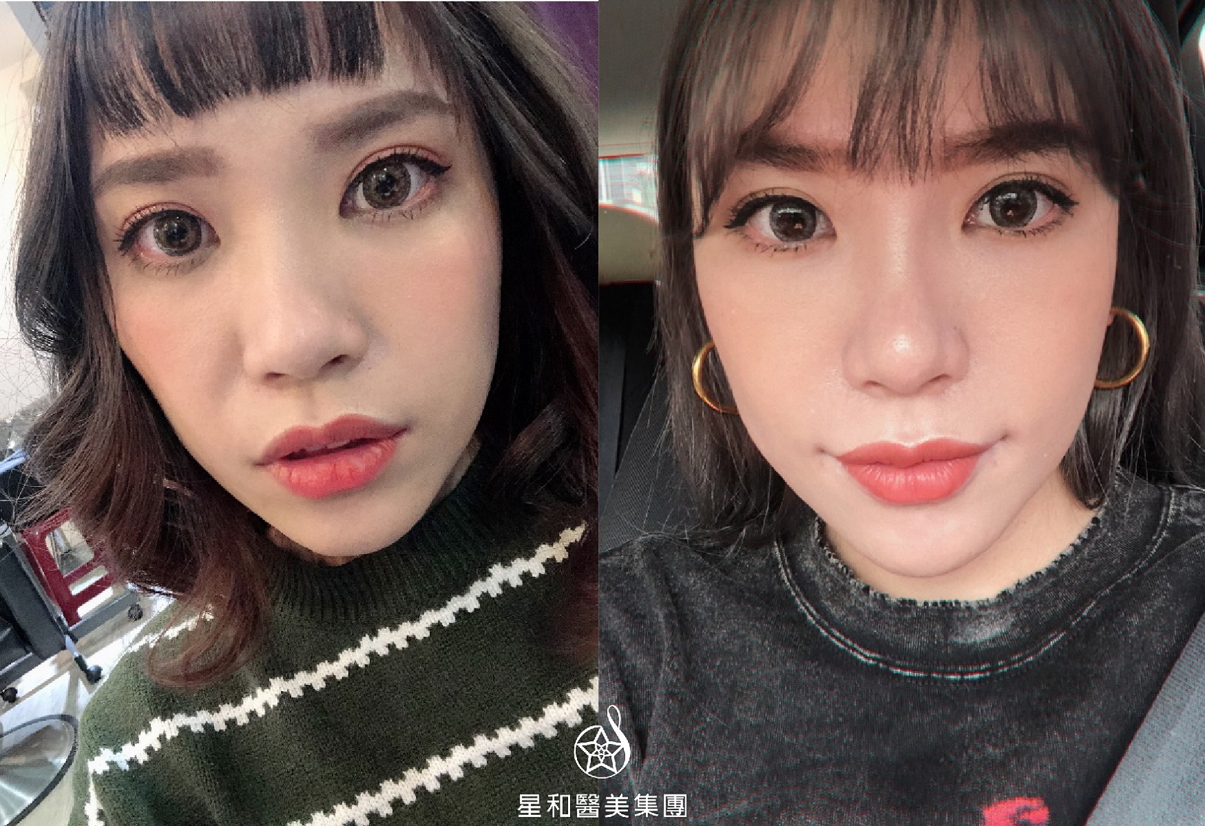 【玻尿酸】