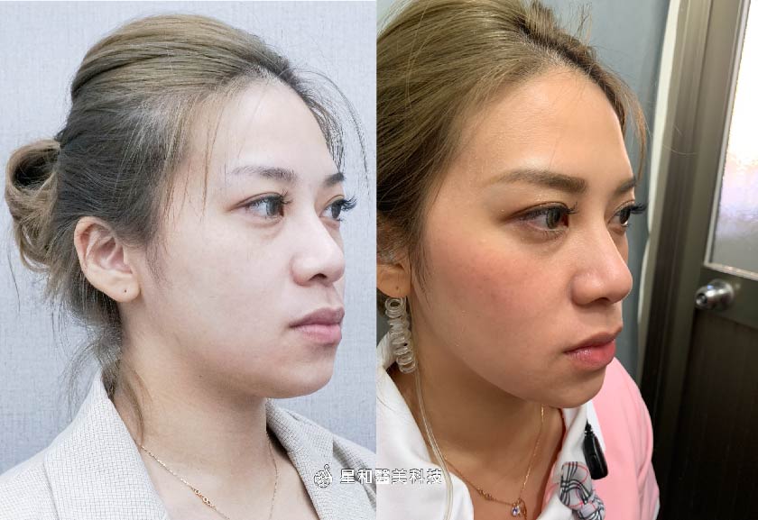 【女神動態玻尿酸+舒顏萃】星和診所（新竹市）-黃伊寧醫師-偷偷的、慢慢的、不動刀的變漂亮(下)-Queena