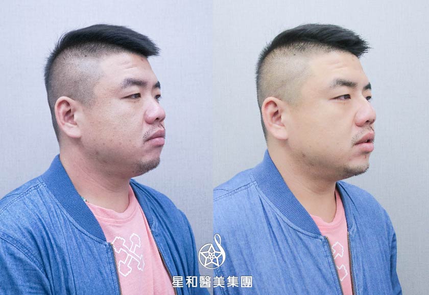 【玻尿酸山根+下巴】星和診所（新竹）-薛博今醫師-人生短短幾個秋，玻尿酸讓你不美不罷休！(下)-Jako
