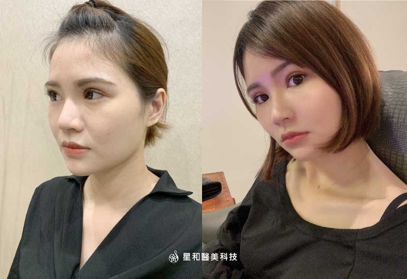 【自體脂肪補臉】星和診所/台中醫美-Byebye厚重瀏海，秀出飽滿額頭與瓜子臉的小秘密-Tracy(中)