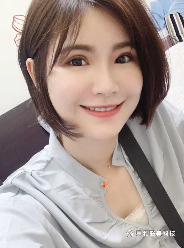 【自體脂肪補臉】星和診所/台中醫美-Byebye厚重瀏海，秀出飽滿額頭與瓜子臉的小秘密-Tracy(下)
