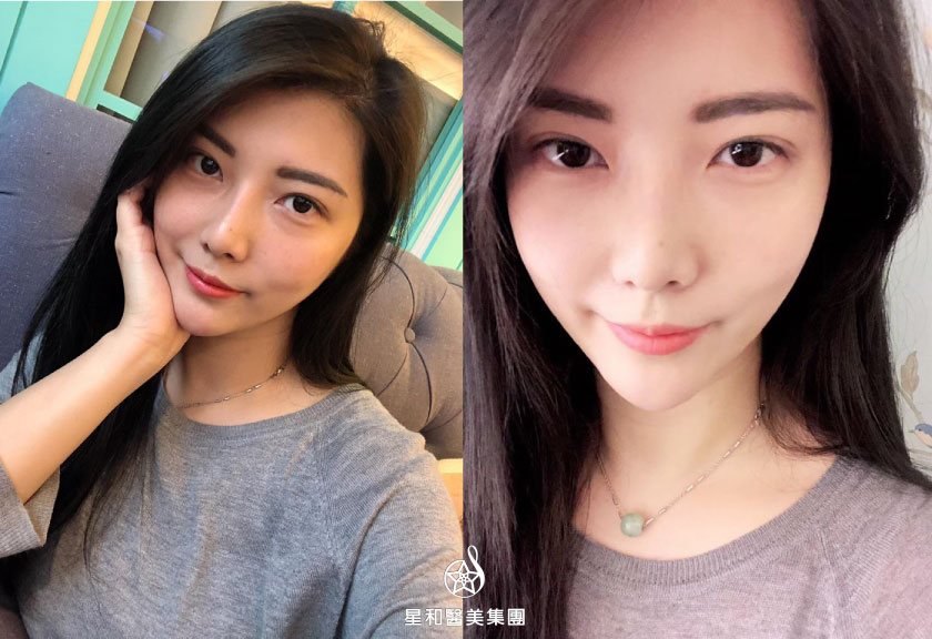【玻尿酸】