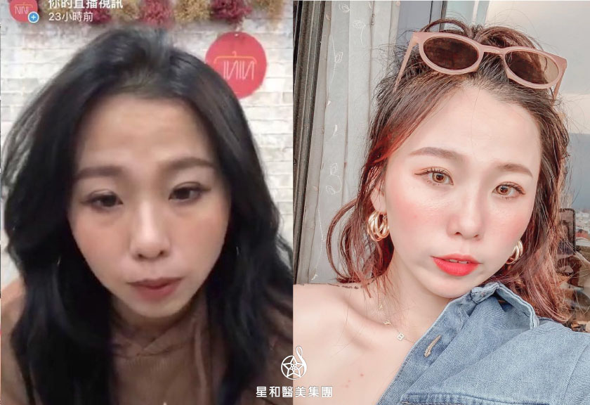 【玻尿酸】