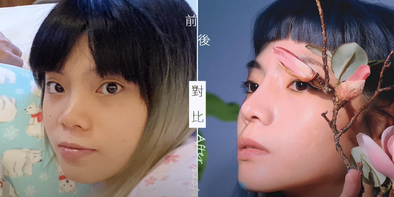 【半自肋結構式鼻整形】