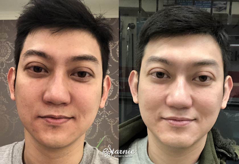 玻尿酸下巴