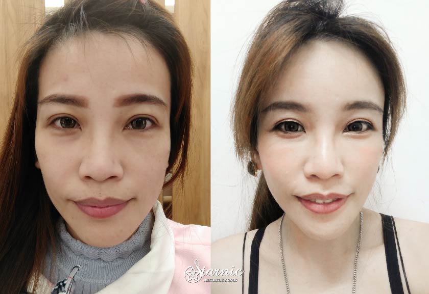 自體脂肪補臉