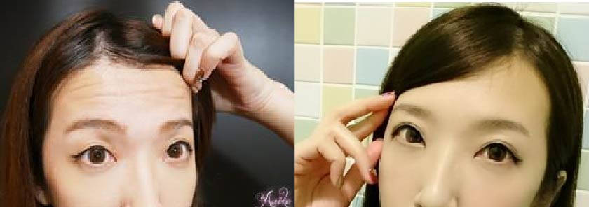【微整除皺+淨膚雷射】