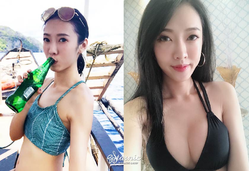 果凍隆乳(曼陀矽膠填充義乳)