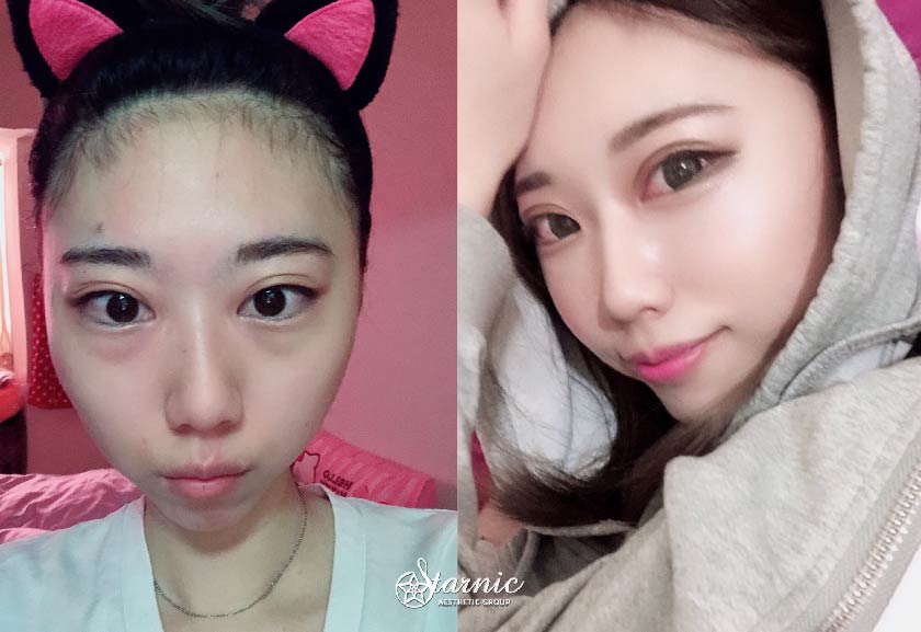 玻尿酸淚溝