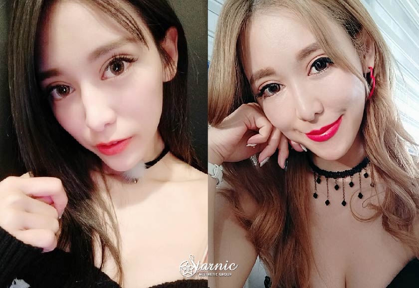 【自體脂肪補臉】星和診所/高雄醫美-就是要少女肌的澎潤感，和凹陷臉頰說ByeBye-愛佳奈(上)