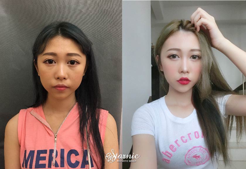 瘦小臉注射