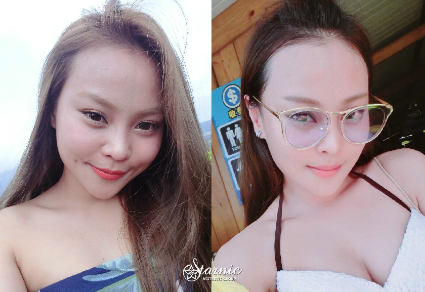 【肉毒桿菌瘦小臉】 高雄醫美星和診所/鄭玉貞醫師-方形臉救星！愛上肉毒的我~-Apple