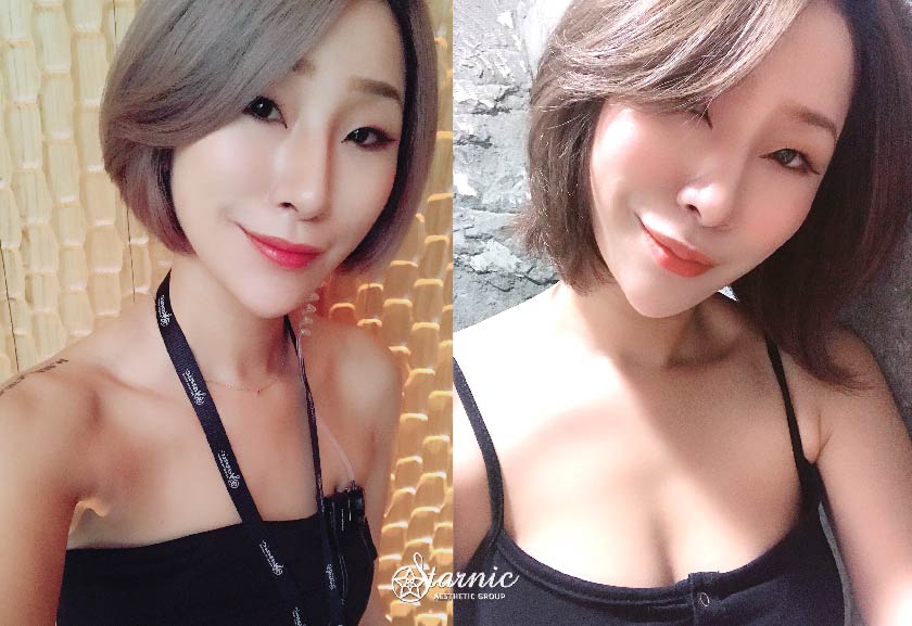 【自體脂肪隆乳】星和診所/台中醫美-不只胸部美，身形也美！我終於也有了不起的長輩-Bonnie(下)