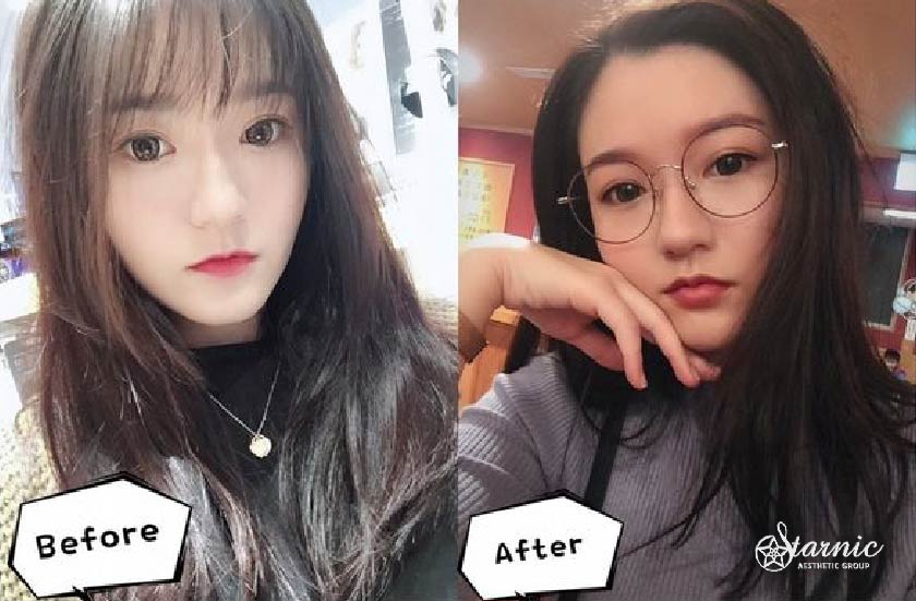 玻尿酸豐唇