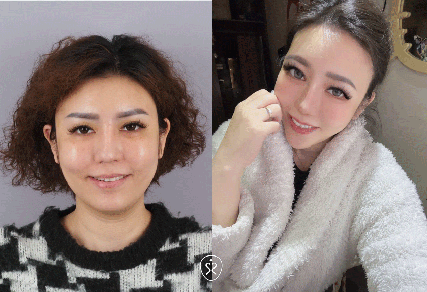 【二代隱形矯正】