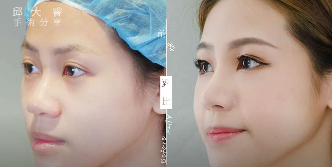三段式隆鼻+縮鼻翼