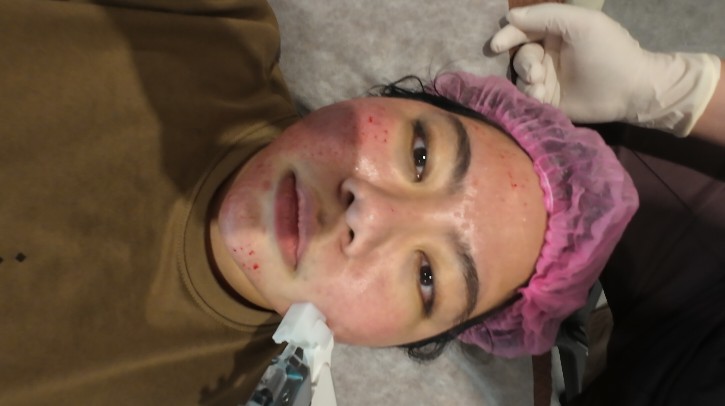 修秘水光注射過程
