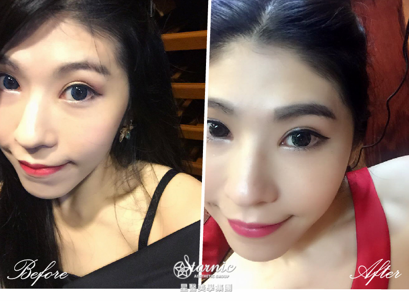 【Ellanse洢蓮絲蘋果肌】星和診所（新竹市） 陳明如醫師-告別兇巴巴高顴骨的日子(下)-丁法法