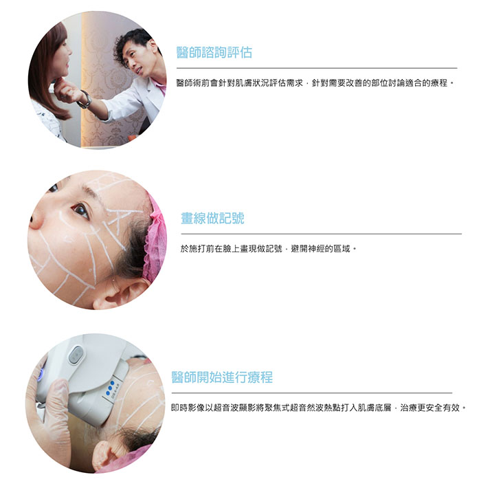 【極線音波拉提】不想變成黃臉婆? 極線音波拉提對付老垂臉！ - 星采星和醫美