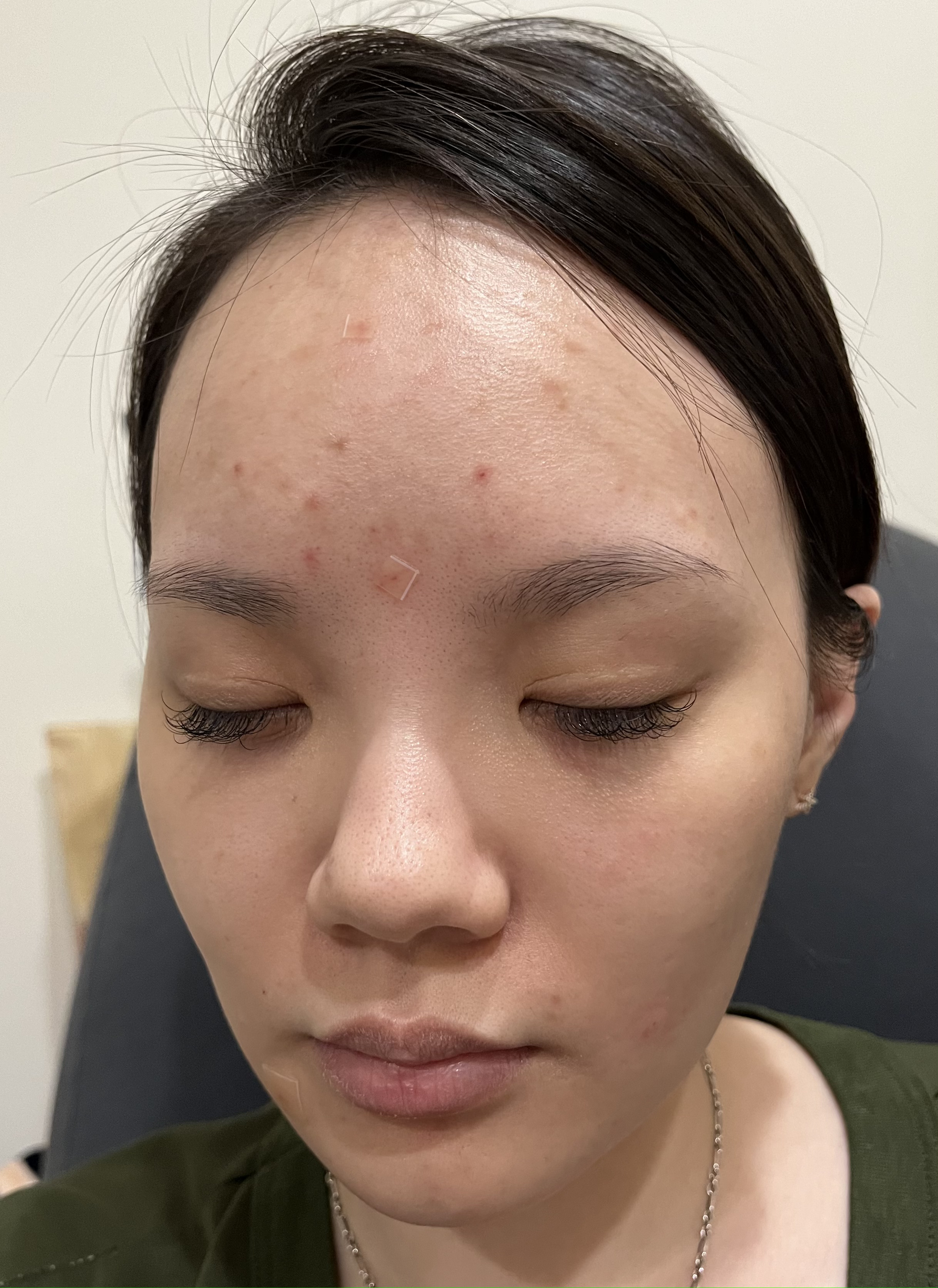 修秘水光注射術後7天成果