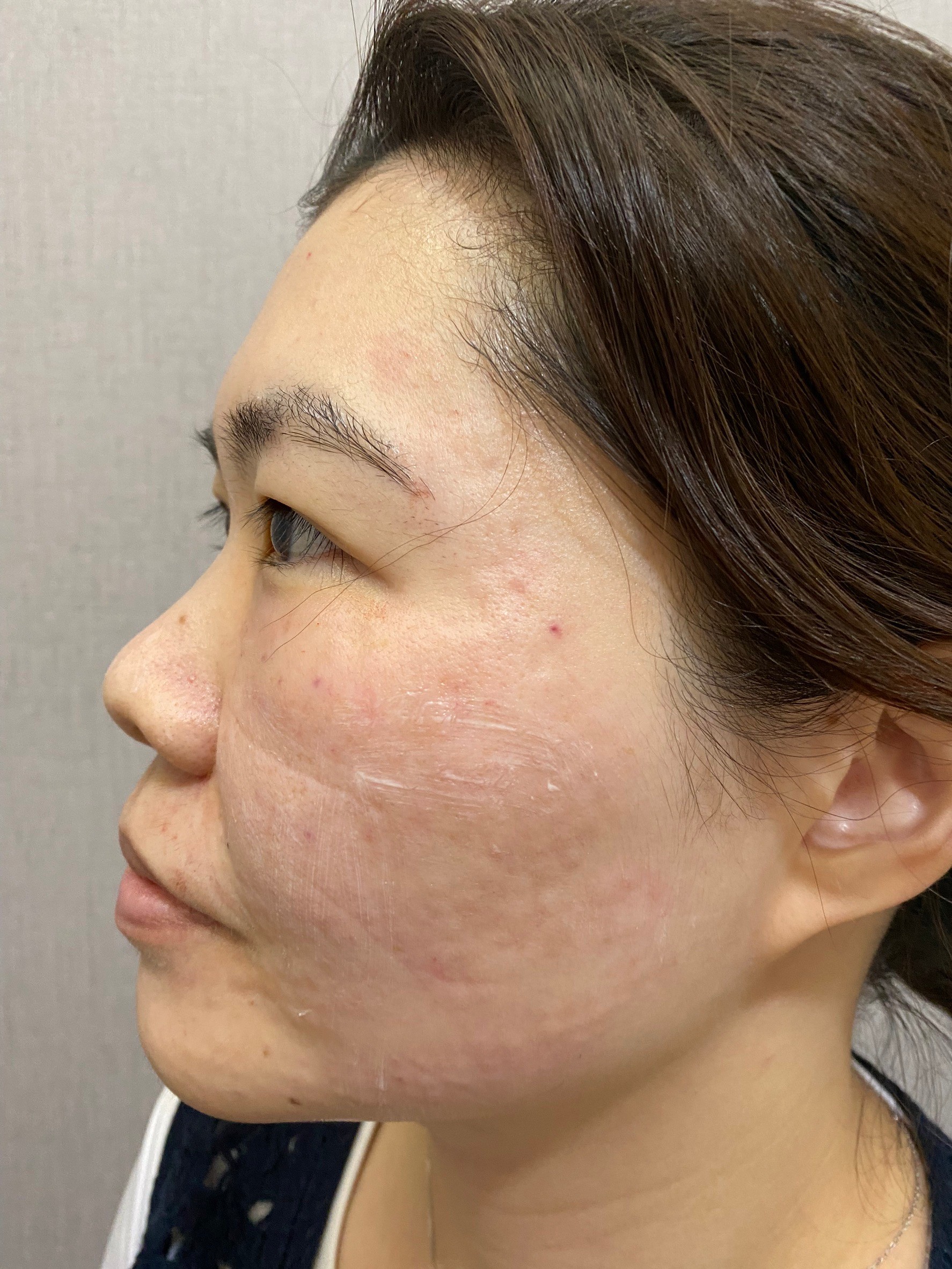水光施打後冰敷與上藥膏