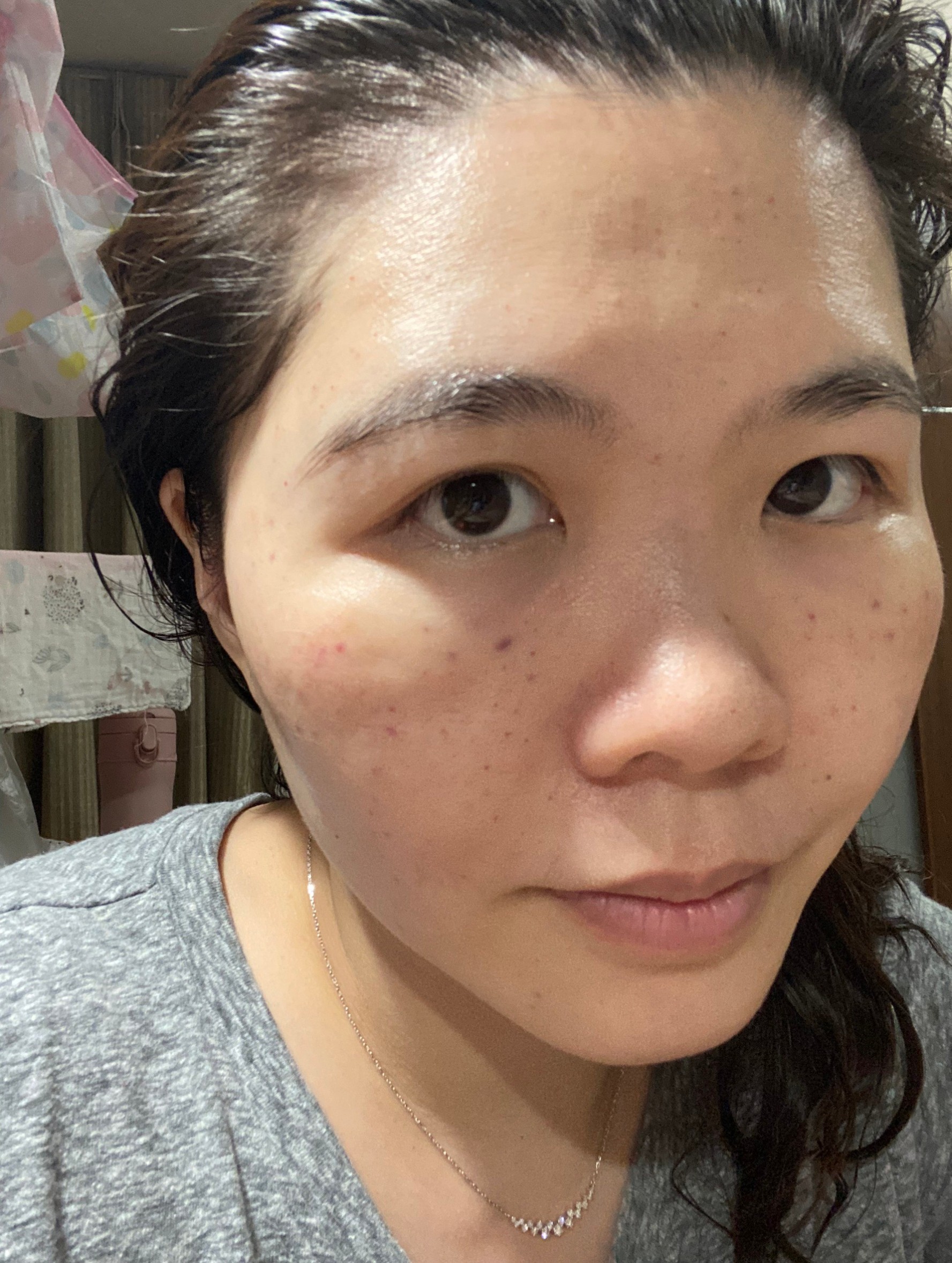 修秘水光當天晚上術後恢復紀錄