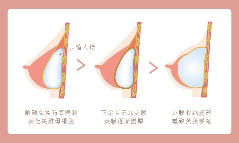 甚麼是莢膜攣縮 Capsular Contracture