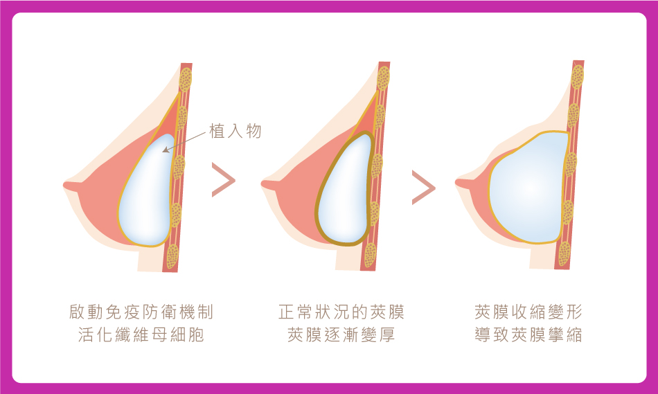 什麼是莢膜攣縮(Capsular Contracture)?