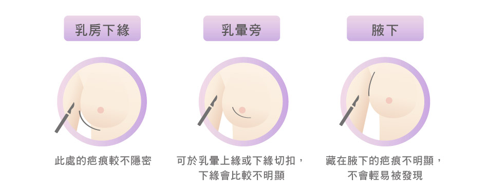 隆乳手術常見的切口位置