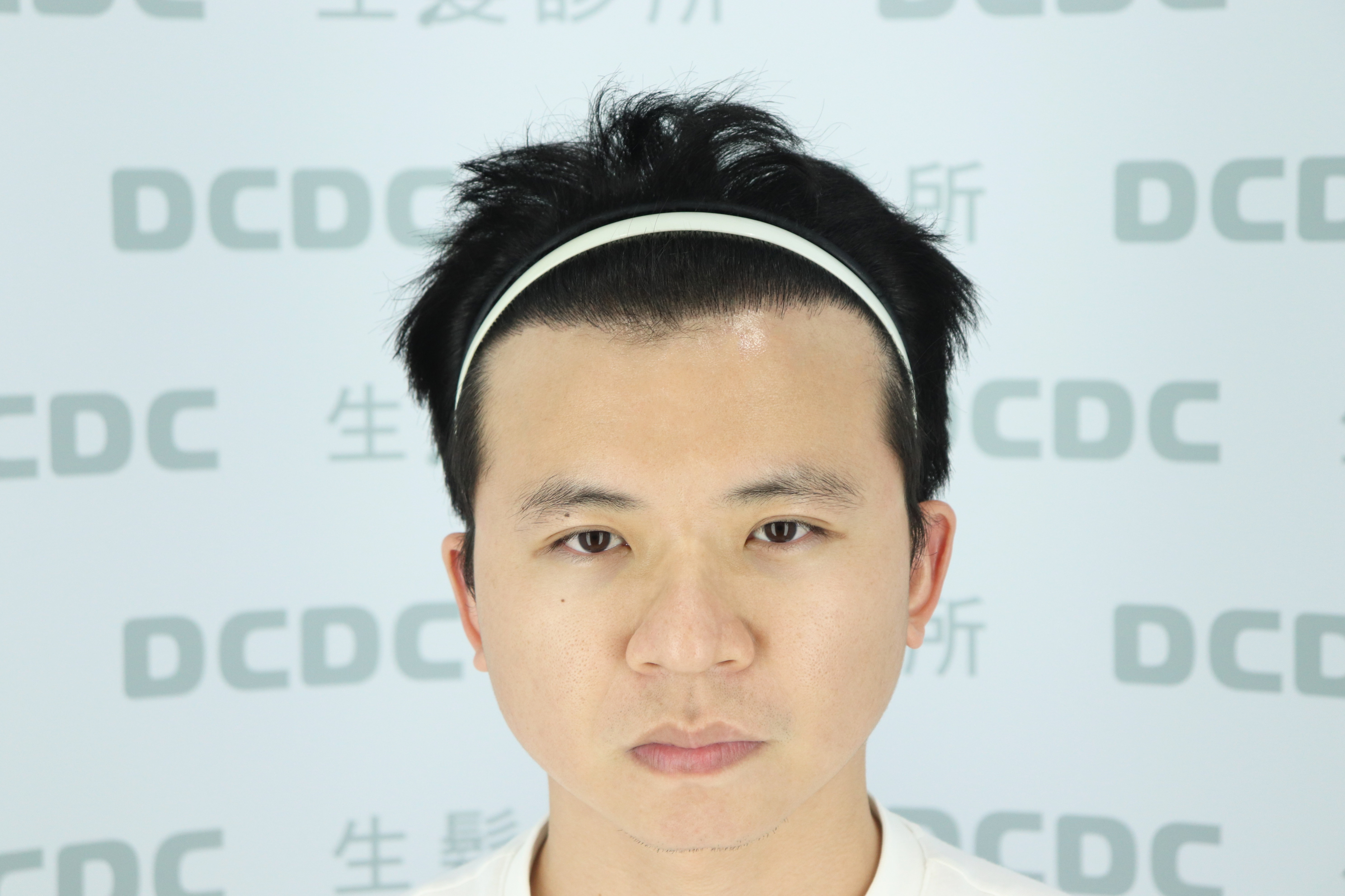 DCDC生髮診所-方孝俤醫師植髮6008根術後9個月前額濃密正面成果