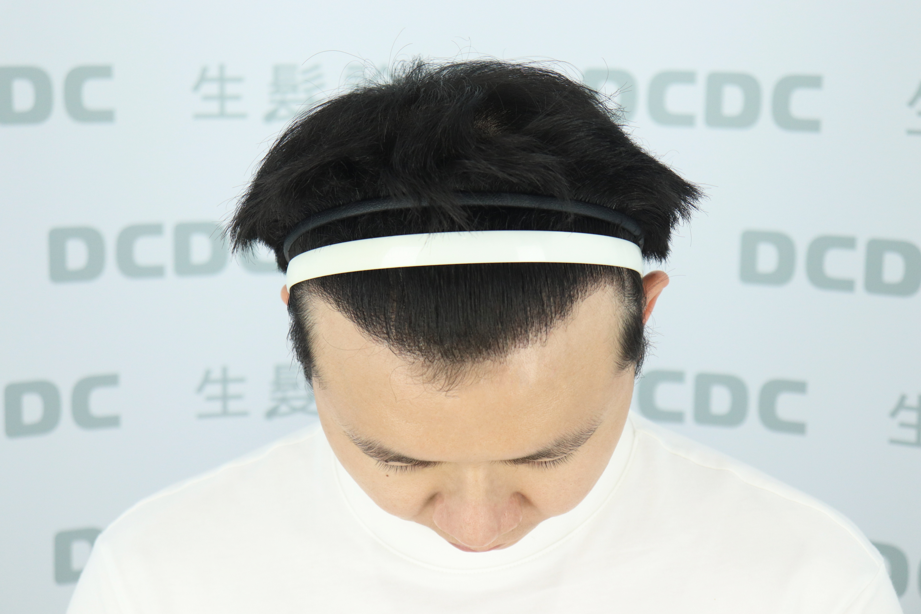 DCDC生髮診所-嚴重M型禿植髮填補術後9個月飽滿前額線條