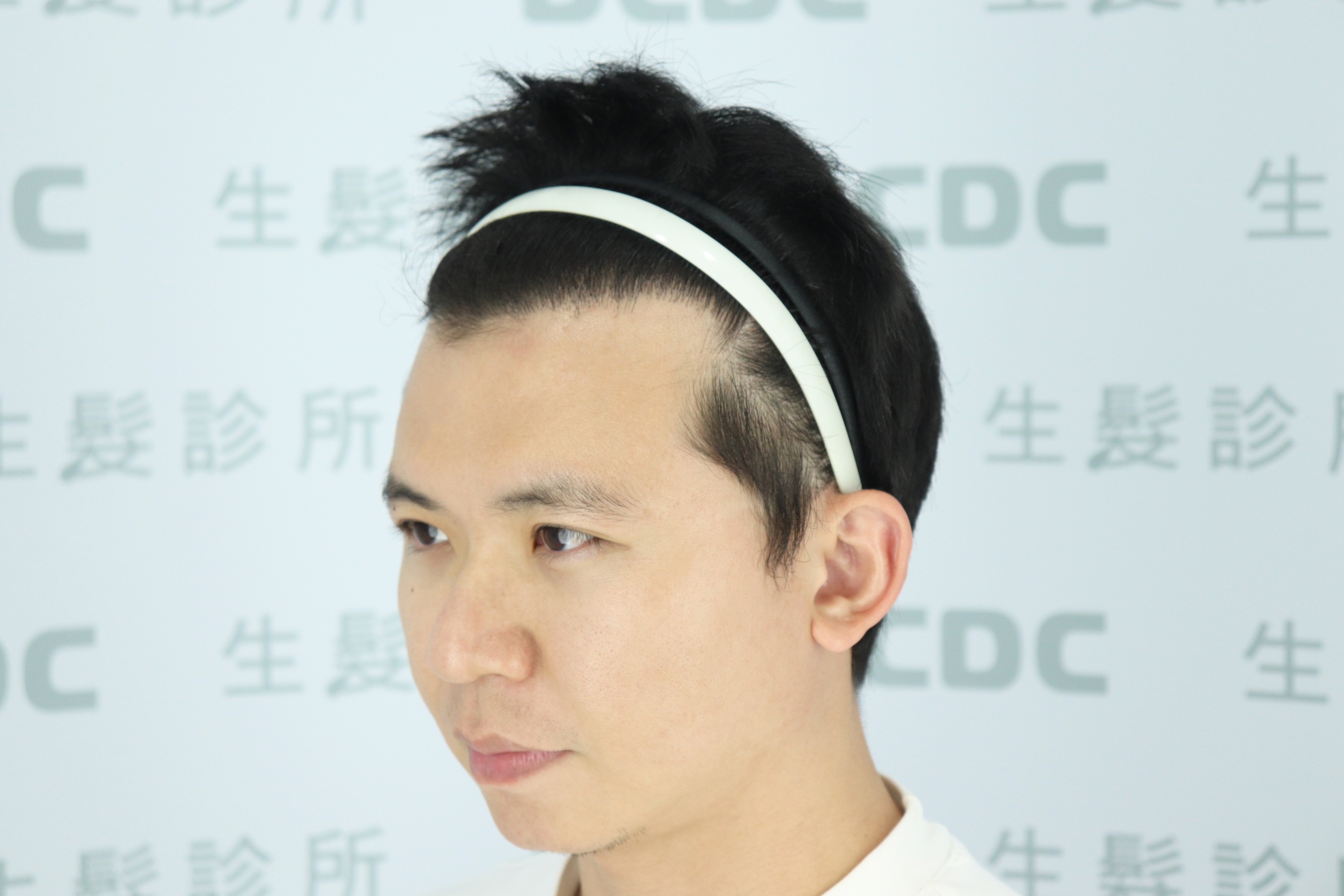 DCDC生髮診所-大面積雄性禿FUE植髮術後9個月側臉濃密成果