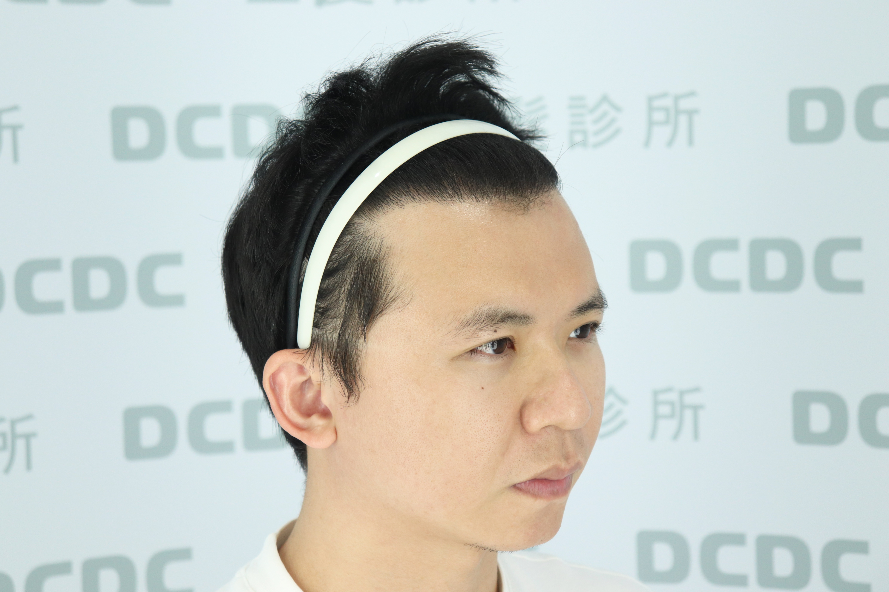 DCDC生髮診所-前額毛流自然服貼高密度重生術後成果