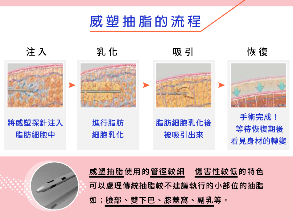 超音波抽脂/威塑抽脂的原理及施作流程