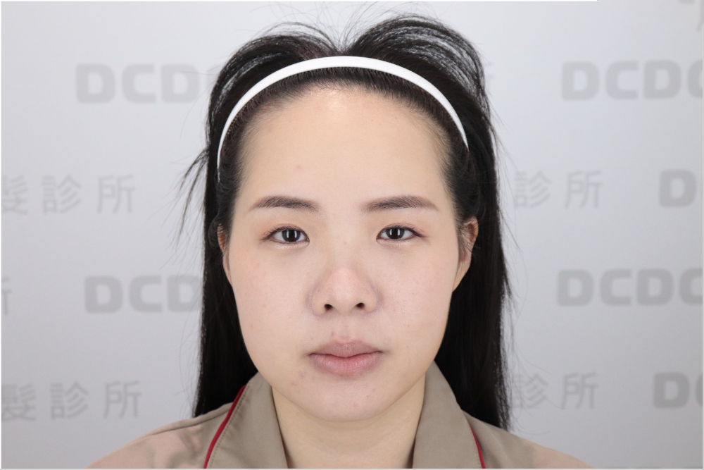 DCDC植髮診所-女性高額頭與兩側額角稀疏術前評估