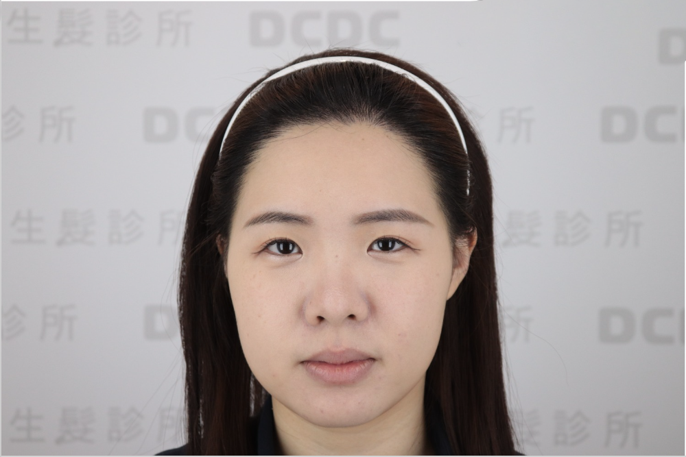 DCDC植髮診所-鍾醫師FUE美型髮際線植髮2702根術後自然濃密正面成果