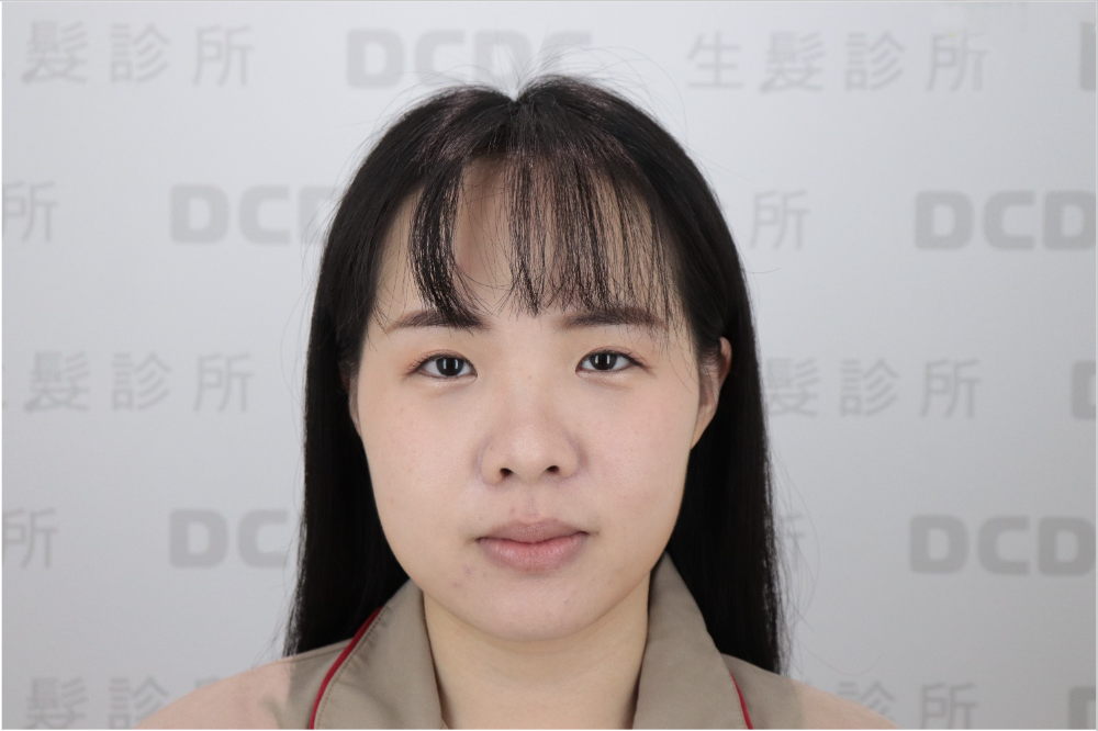 DCDC植髮診所-女性美型髮際線客製化術前側臉線條檢視