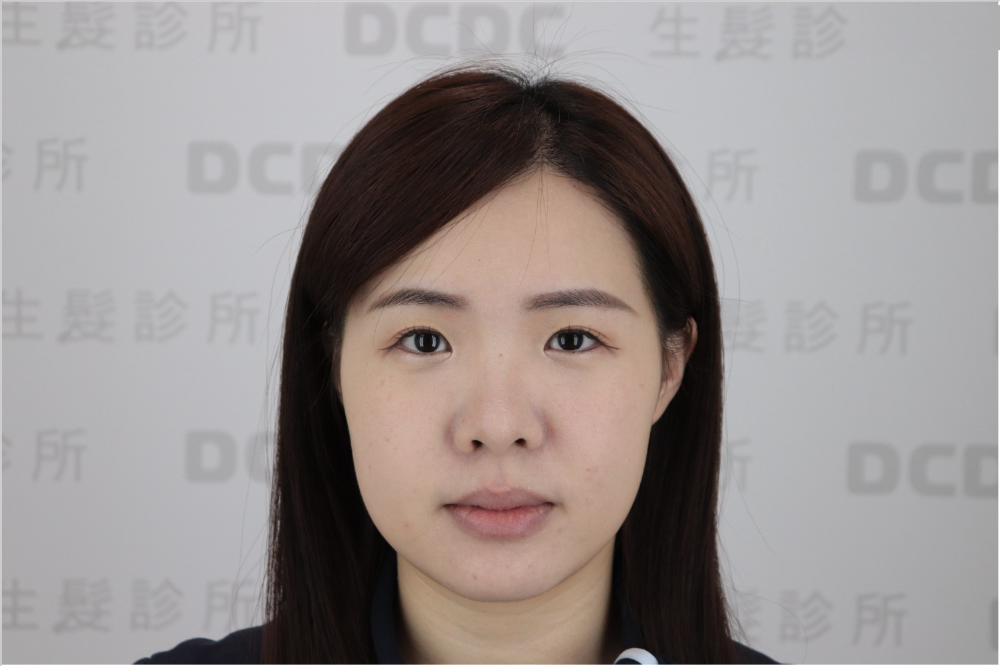 DCDC植髮診所-客製化女性美型髮際線填補額角修飾小臉術後成果